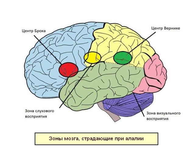 Зоны мозга, поврежденные при алалии
